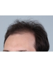 Before Hair Transplant&nbsp;Front